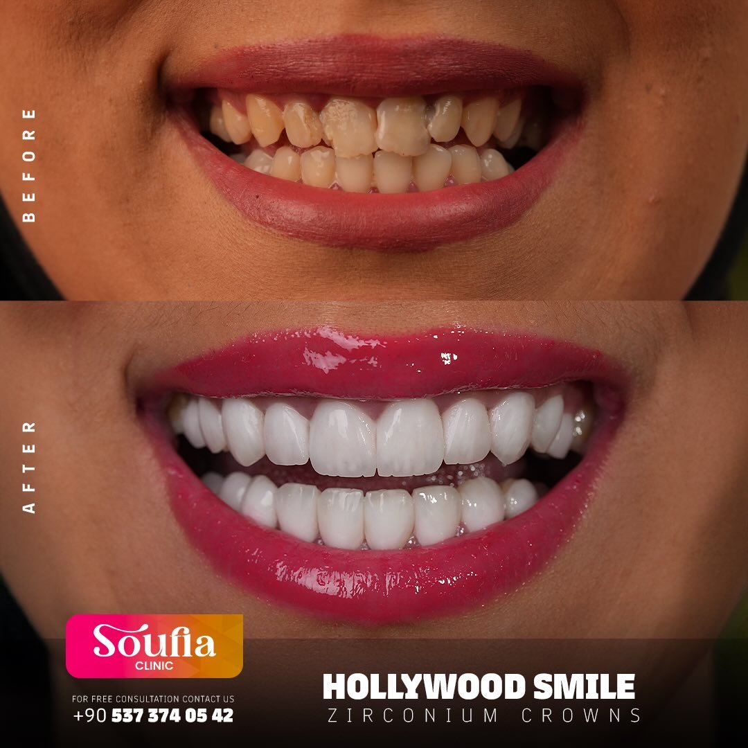 #hollywood_smile #hollywoodsmile #soufia_talouni #soufiaclinic #teeth #dent #dentistry #dental #