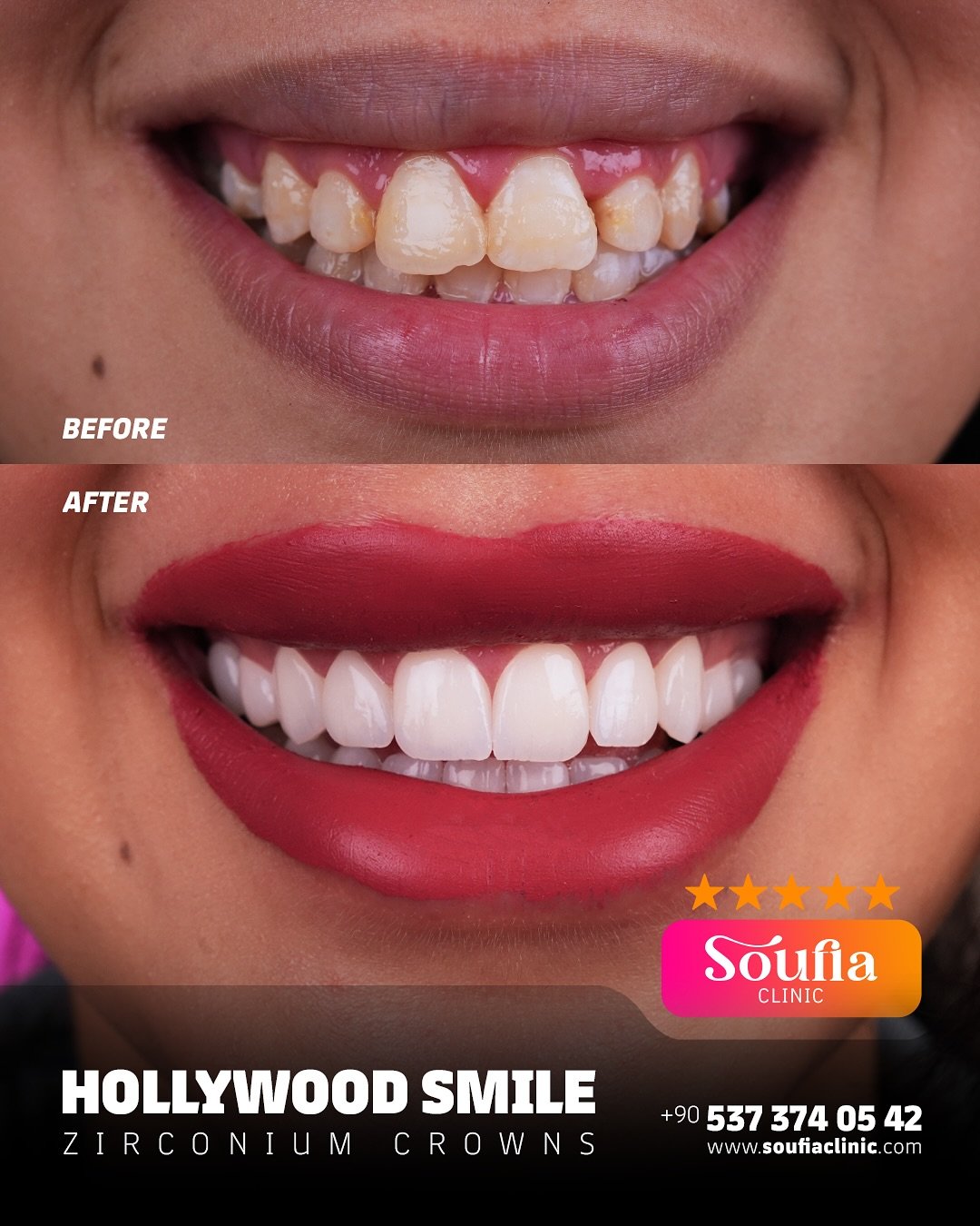 ✨ Transform your smile into pure confidence ✨Achieve the perfect Hollywood Smile with premium zi