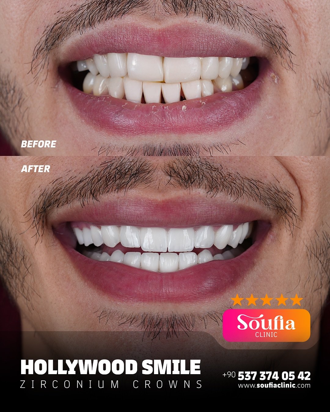 ✨ Transform your smile, transform your confidence ✨From natural imperfections to a flawless Holl